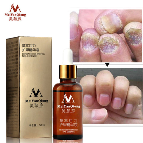 Default Title - Fungal Nail Treatment Essence Nail and Foot Whitening Toe Nail Fungus Removal Feet Nail Care Essential oil