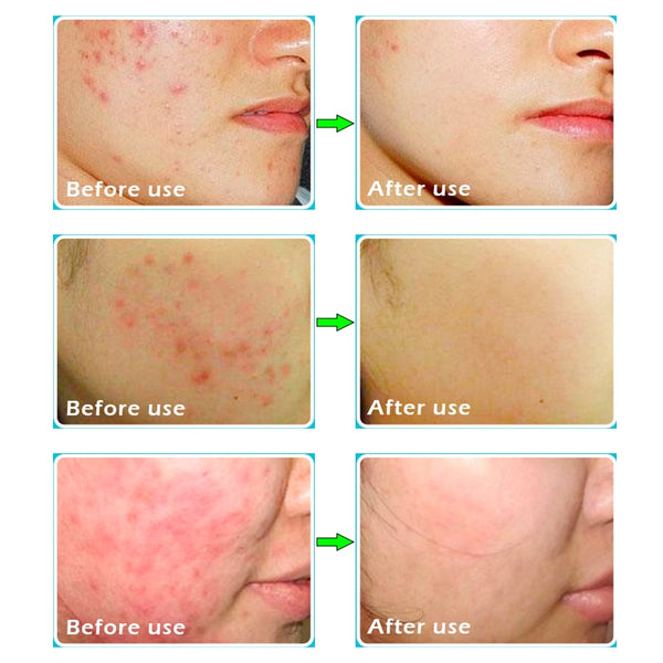 [variant_title] - HEMEIEL Acne Treatment Face Cream Anti Acne Scar Removal Pimple Blackhead Moisturizing Whiten Oil-control Shrink Pores Skin Care